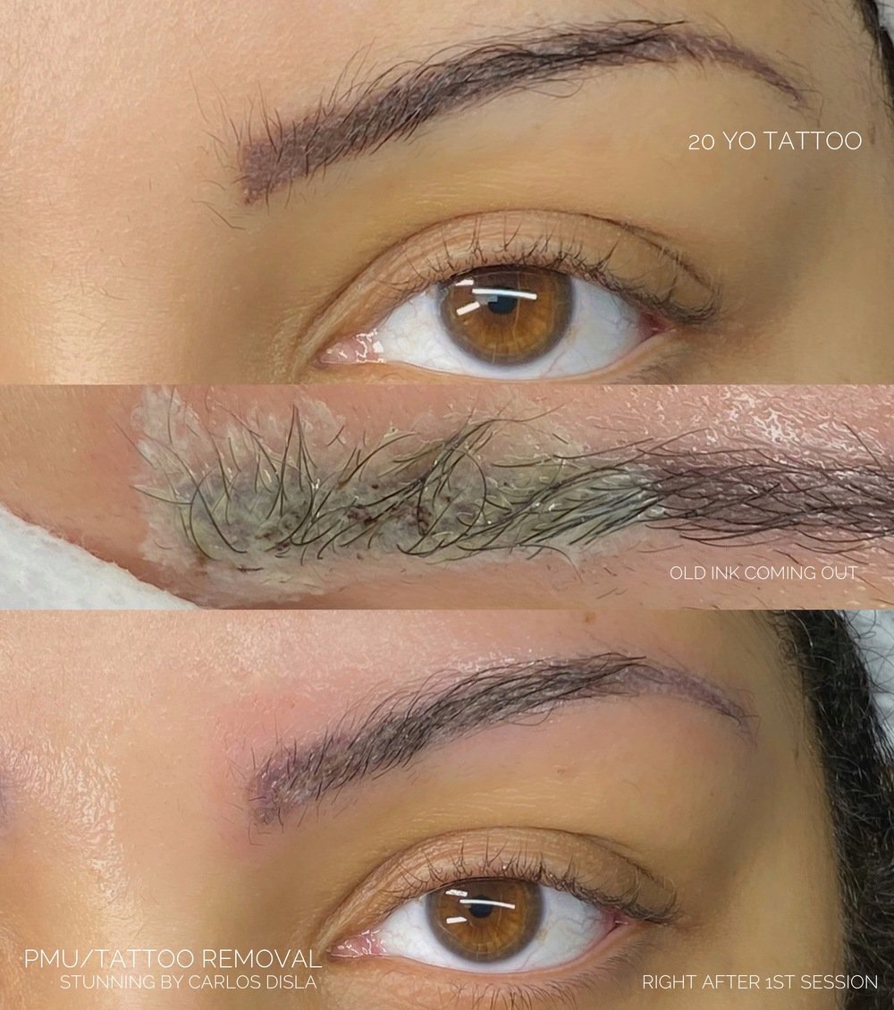 Stunning PMU/Tattoo Removal