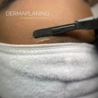 dermaplaning (14)