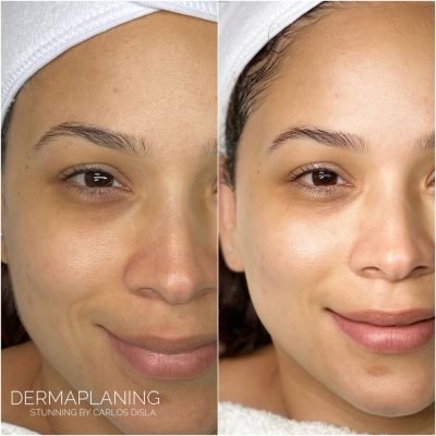 dermaplaning (6)